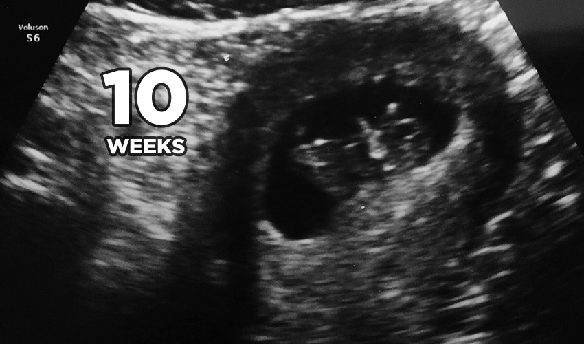 10 week ultrasound